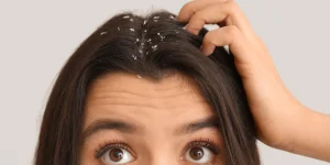 як боротися з перхоттю