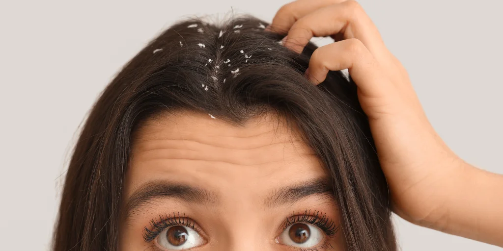 як боротися з перхоттю