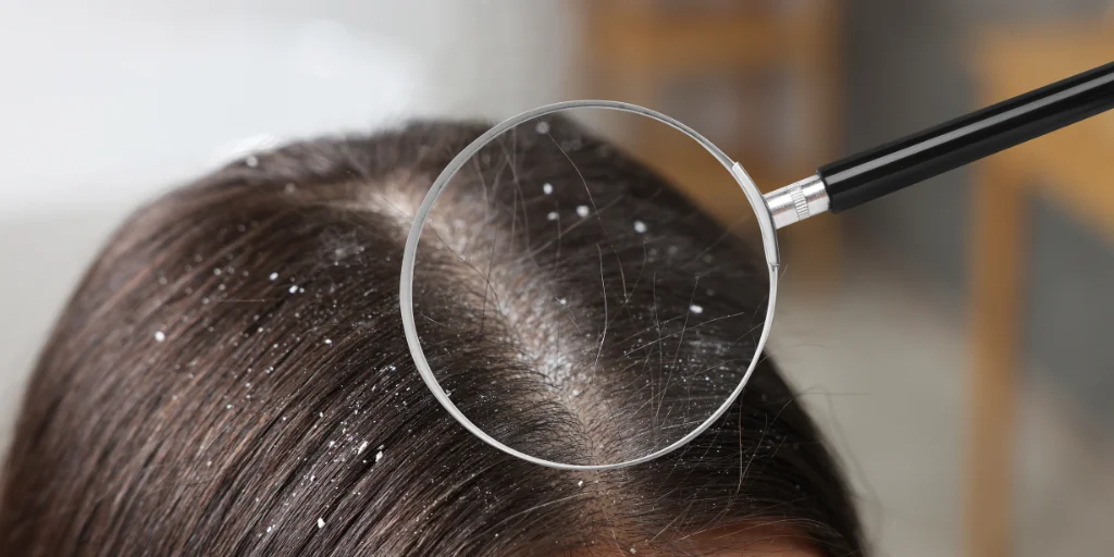 як позбавитися лупи