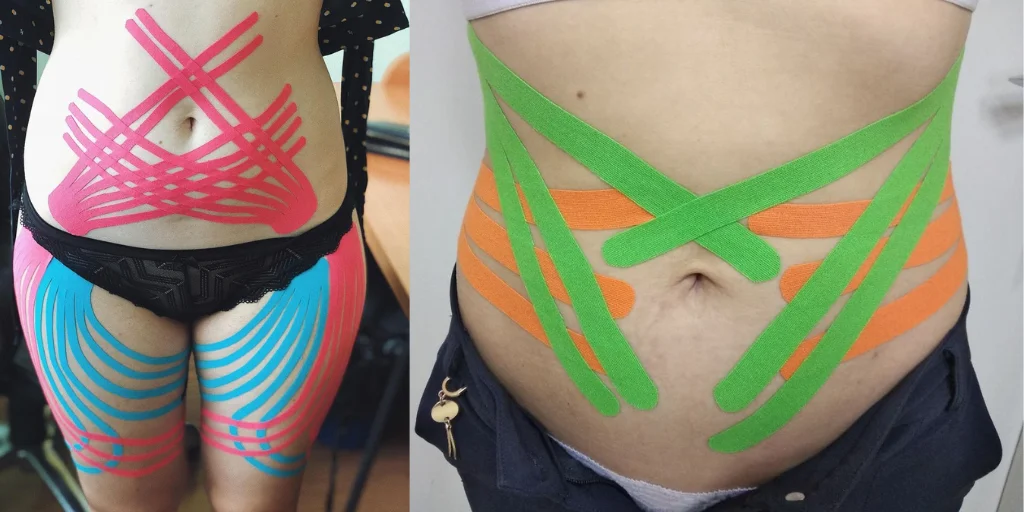 лімфодренажне тейпування живота