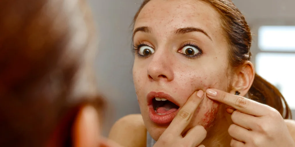 як позбавитись від прищів