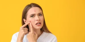 як позбутися прищів за 15 хв в домашніх умовах