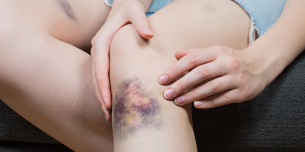 як позбутись синяка за день