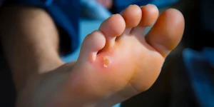 як позбутися мозоля на нозі в домашніх умовах