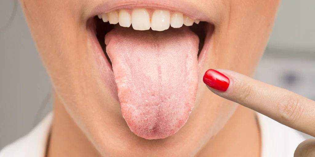 как избавиться от белого налета на языке