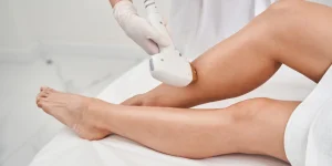 лазерна епіляція